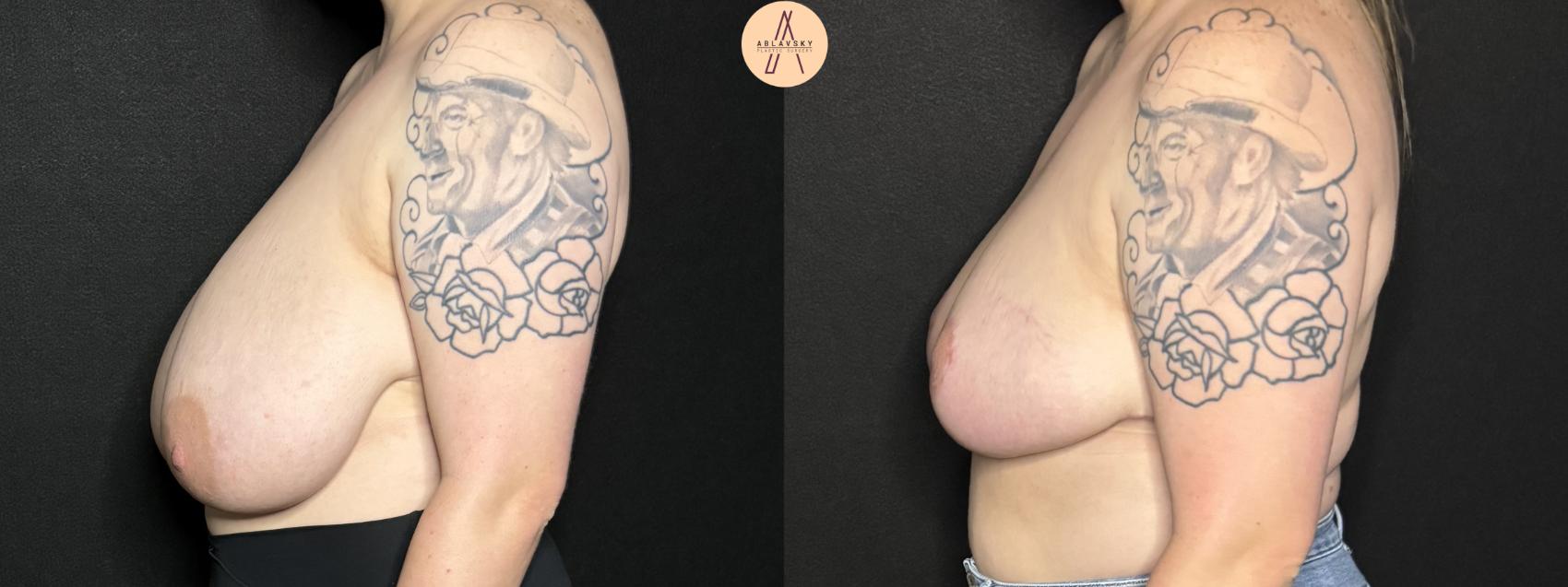 Before & After Breast Reduction Case 260 Left Side View in San Antonio, Texas