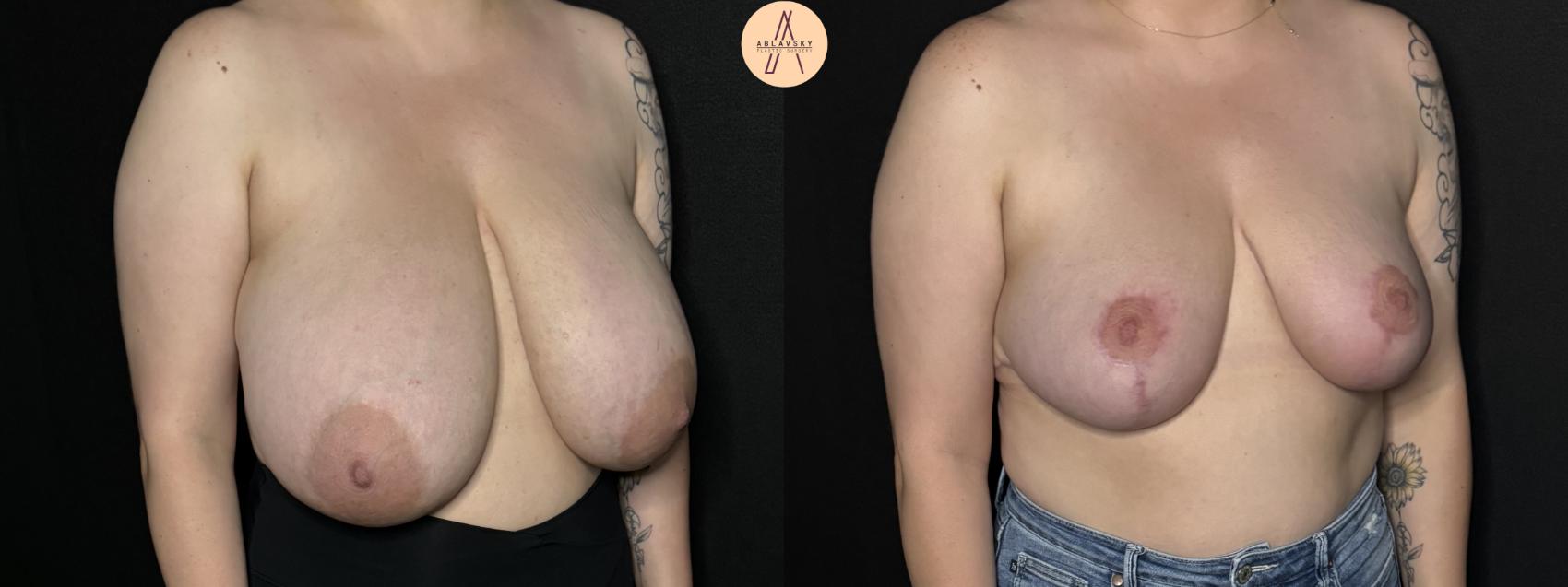Before & After Breast Reduction Case 260 Right Oblique View in San Antonio, Texas