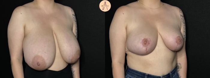 Before & After Breast Reduction Case 260 Right Oblique View in San Antonio, Texas