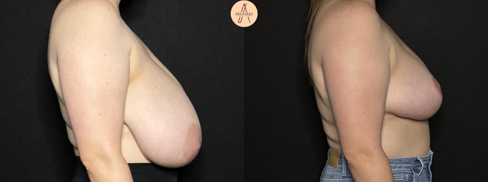 Before & After Breast Reduction Case 260 Right Side View in San Antonio, Texas