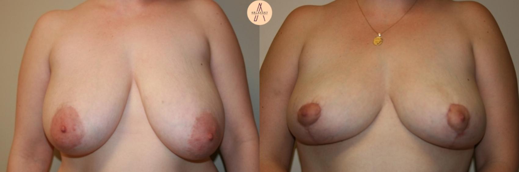 Before & After Breast Lift Case 28 Front View in San Antonio, Texas