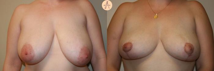 Before & After Breast Reduction Case 28 Front View in San Antonio, Texas