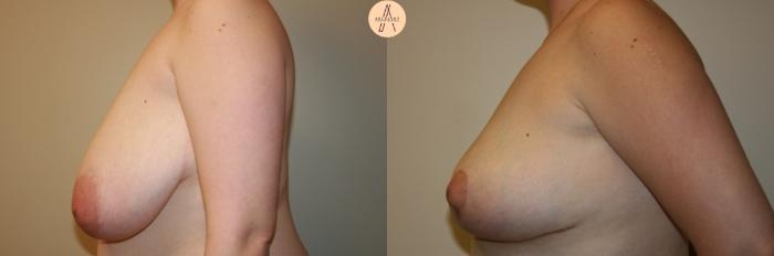 Before & After Breast Reduction Case 28 Left Side View in San Antonio, Texas
