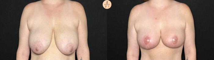 Before & After Breast Reduction Case 285 Front View in San Antonio, Texas