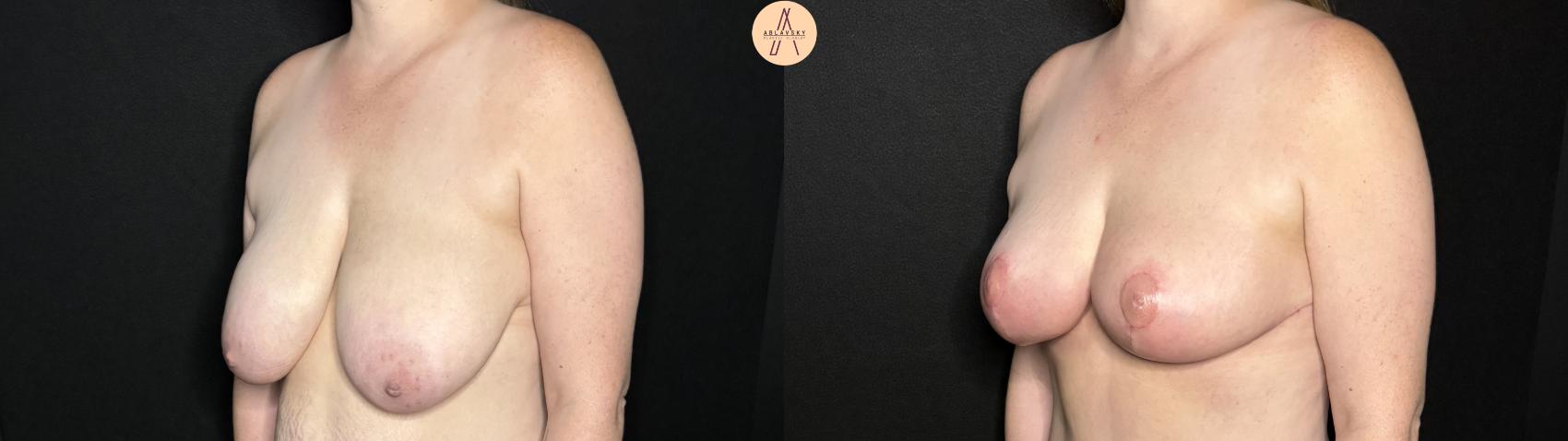 Before & After Breast Lift Case 285 Left Oblique View in San Antonio, Texas