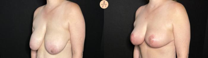 Before & After Breast Reduction Case 285 Left Oblique View in San Antonio, Texas