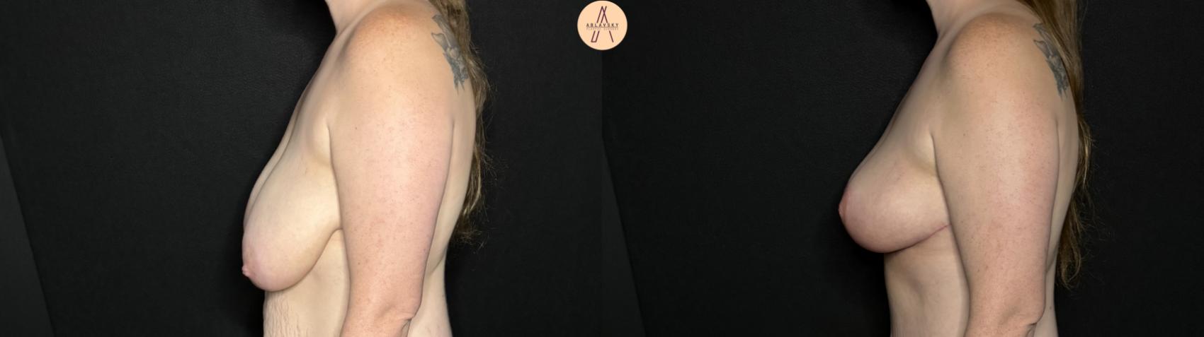 Before & After Breast Lift Case 285 Left Side View in San Antonio, Texas