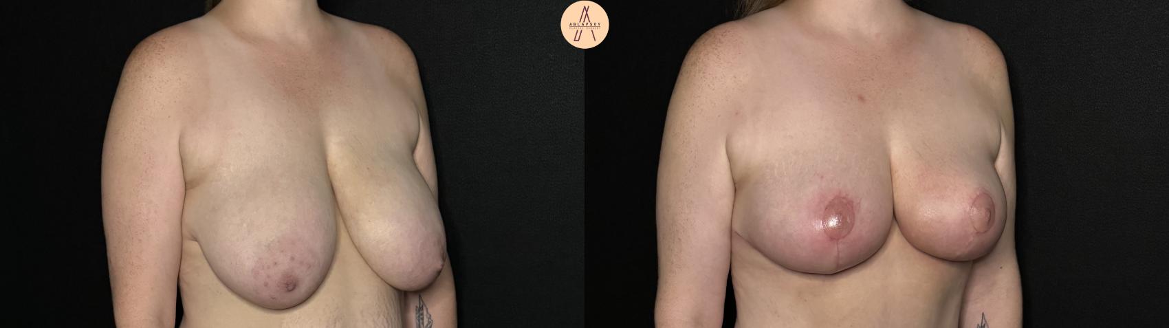 Before & After Breast Lift Case 285 Right Oblique View in San Antonio, Texas