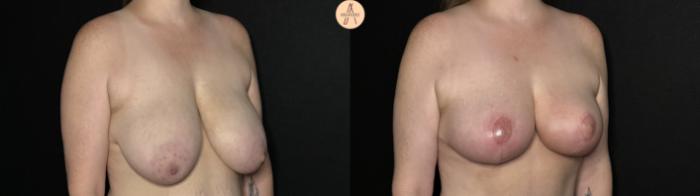 Before & After Breast Reduction Case 285 Right Oblique View in San Antonio, Texas