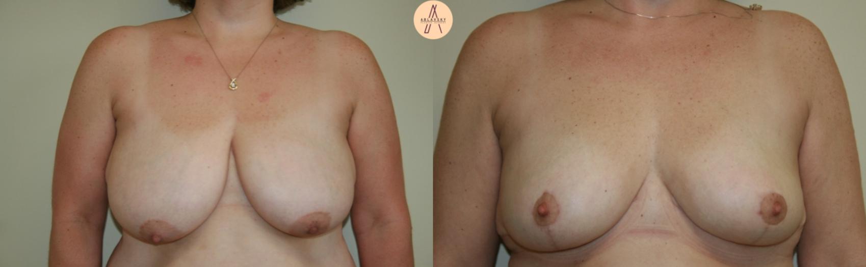 Before & After Breast Lift Case 29 Front View in San Antonio, Texas