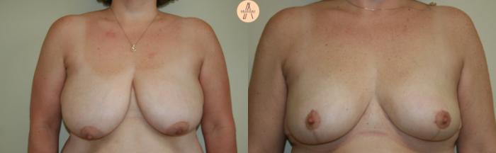 Before & After Breast Reduction Case 29 Front View in San Antonio, Texas