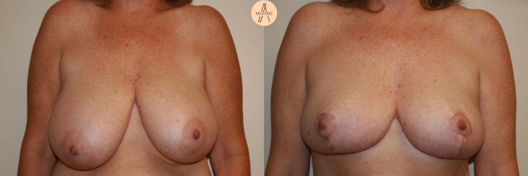 Before & After Breast Lift Case 30 Front View in San Antonio, Texas
