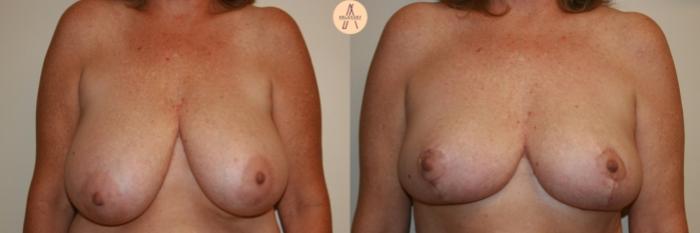 Before & After Breast Reduction Case 30 Front View in San Antonio, Texas