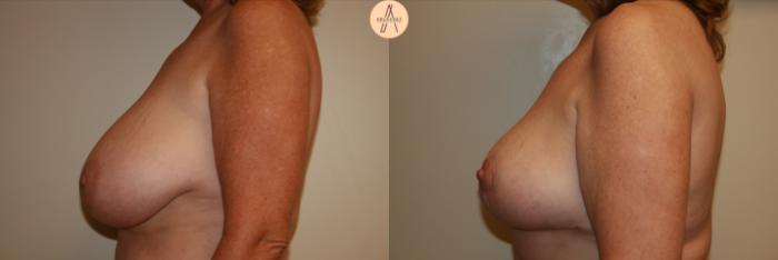 Before & After Breast Reduction Case 30 Left Side View in San Antonio, Texas