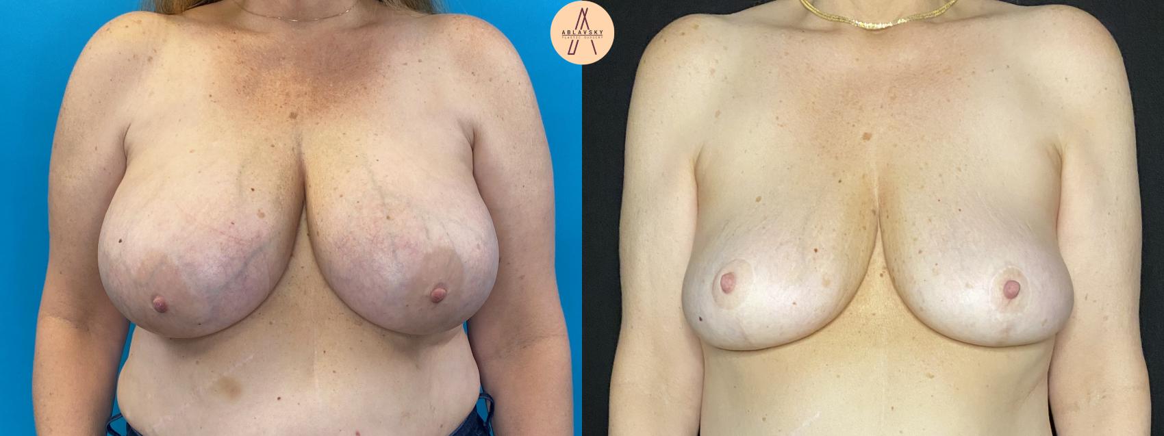 Before & After Breast Lift Case 33 Front View in San Antonio, Texas