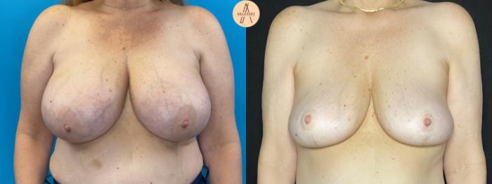 Before & After Breast Reduction Case 33 Front View in San Antonio, Texas