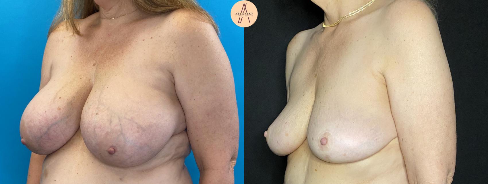 Before & After Breast Lift Case 33 Left Oblique View in San Antonio, Texas