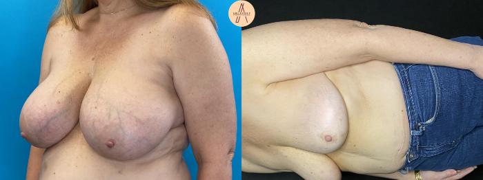 Before & After Breast Reduction Case 33 Left Oblique View in San Antonio, Texas