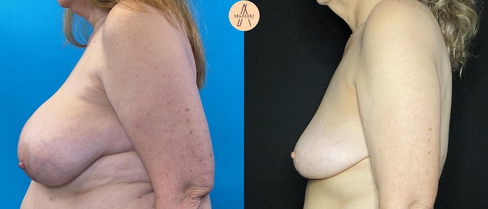 Before & After Breast Lift Case 33 Left Side View in San Antonio, Texas