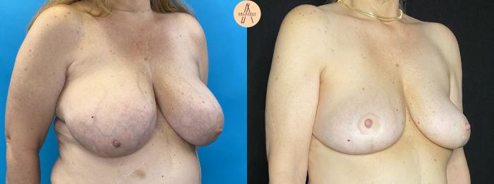 Before & After Breast Lift Case 33 Right Oblique View in San Antonio, Texas