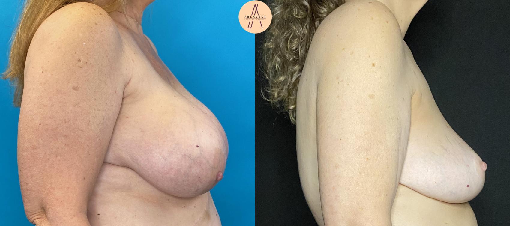 Before & After Breast Lift Case 33 Right Side View in San Antonio, Texas