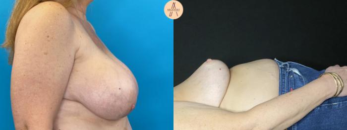 Before & After Breast Lift Case 33 Right Side View in San Antonio, Texas