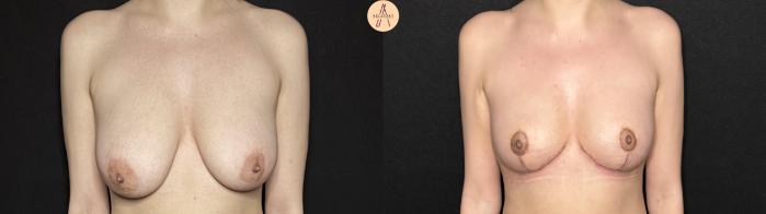 Before & After Breast Reduction Case 377 Front View in San Antonio, Texas