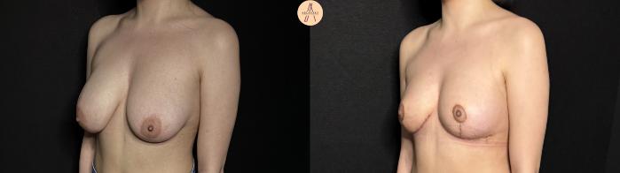 Before & After Breast Reduction Case 377 Left Oblique View in San Antonio, Texas