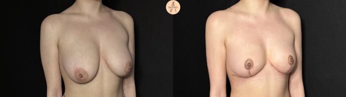 Before & After Breast Reduction Case 377 Right Oblique View in San Antonio, Texas