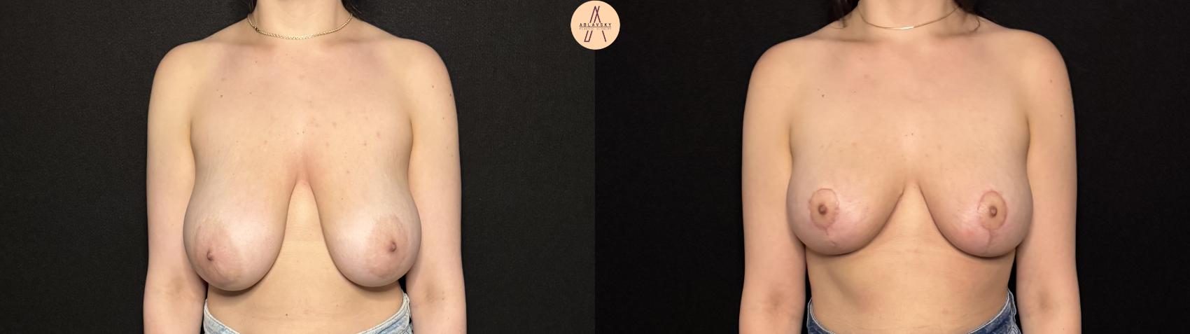 Before & After Breast Lift Case 402 Front View in San Antonio, Texas