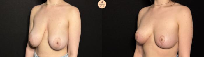 Before & After Breast Lift Case 402 Left Oblique View in San Antonio, Texas