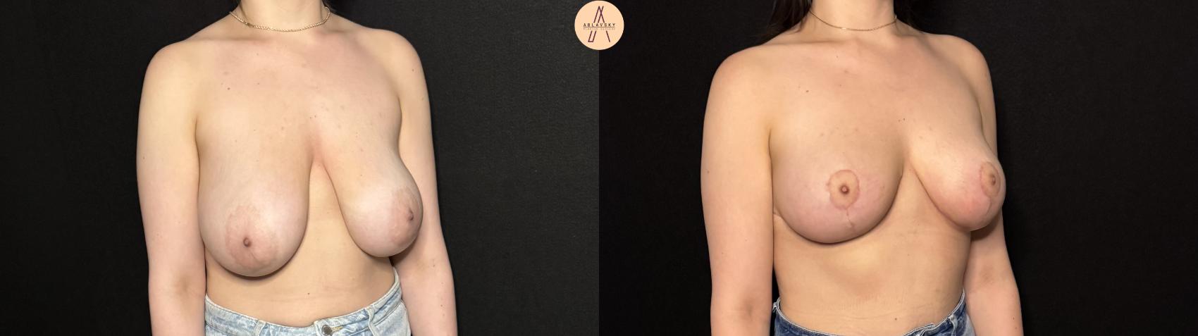 Before & After Breast Lift Case 402 Right Oblique View in San Antonio, Texas