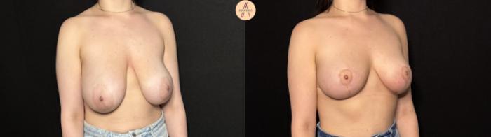 Before & After Breast Lift Case 402 Right Oblique View in San Antonio, Texas