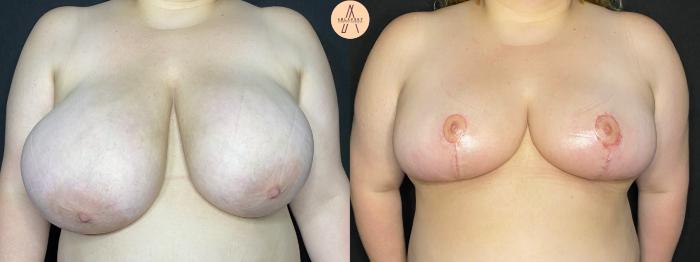 Before & After Breast Reduction Case 41 Front View in San Antonio, Texas