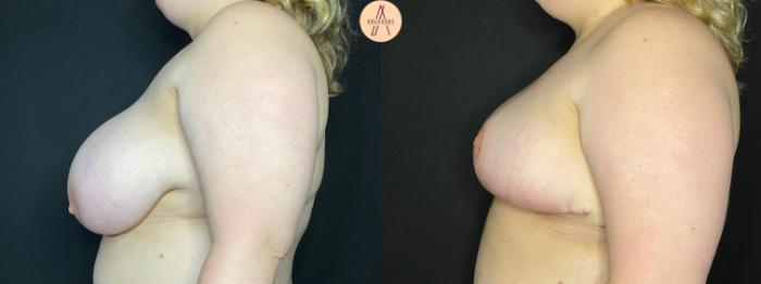 Before & After Breast Reduction Case 41 Left Side View in San Antonio, Texas
