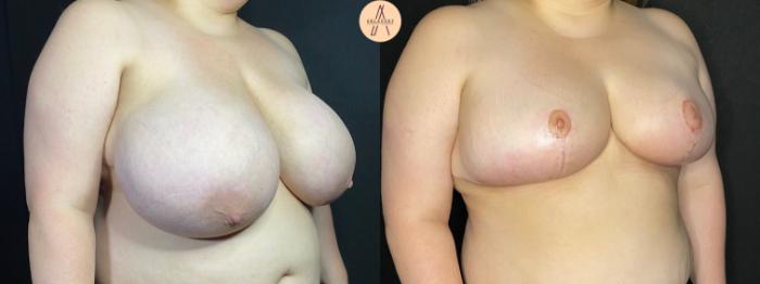 Before & After Breast Reduction Case 41 Right Oblique View in San Antonio, Texas