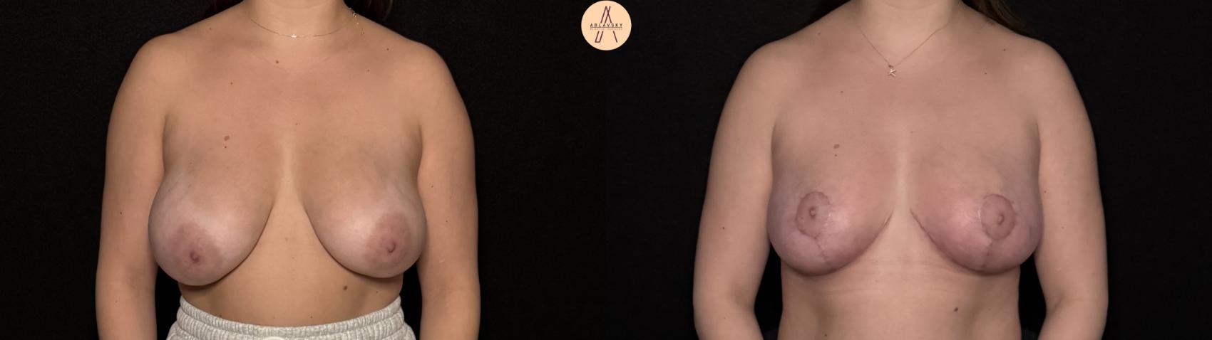 Before & After Breast Reduction Case 495 Front View in San Antonio, Texas