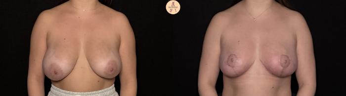 Before & After Breast Reduction Case 495 Front View in San Antonio, Texas