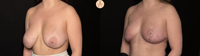 Before & After Breast Reduction Case 495 Left Oblique View in San Antonio, Texas