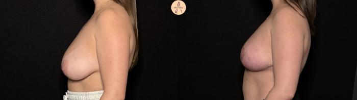 Before & After Breast Reduction Case 495 Left Side View in San Antonio, Texas