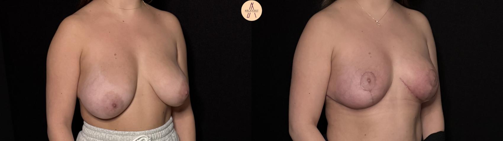 Before & After Breast Reduction Case 495 Right Oblique View in San Antonio, Texas