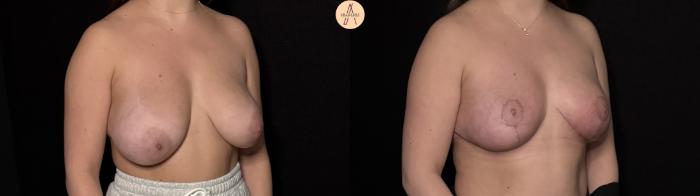 Before & After Breast Reduction Case 495 Right Oblique View in San Antonio, Texas