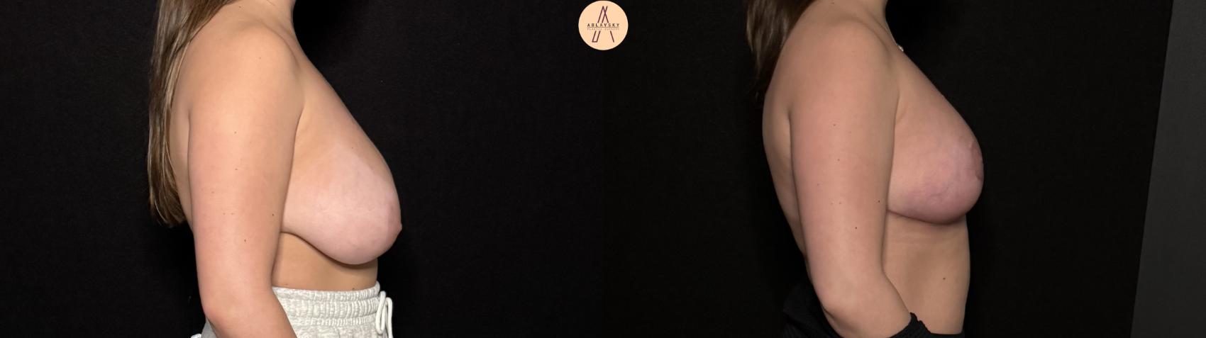 Before & After Breast Reduction Case 495 Right Side View in San Antonio, Texas