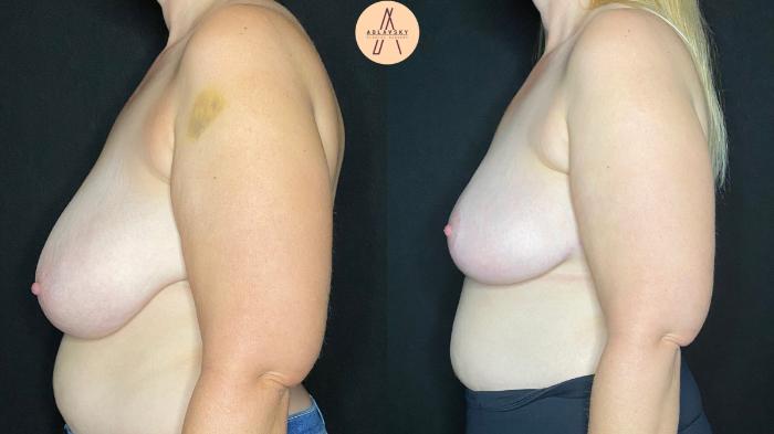 Before & After Breast Reduction Case 87 Left Side View in San Antonio, Texas