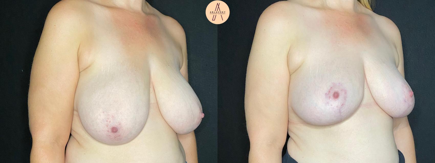 Before & After Breast Reduction Case 87 Right Oblique View in San Antonio, Texas