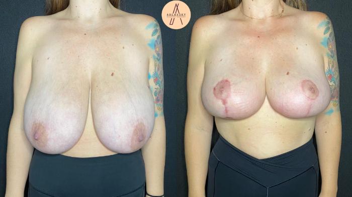 Before & After Breast Reduction Case 90 Front View in San Antonio, Texas