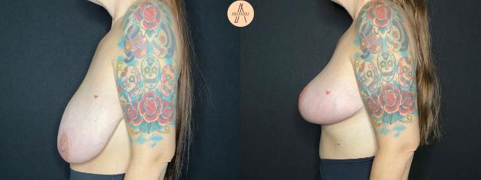 Before & After Breast Reduction Case 90 Left Side View in San Antonio, Texas