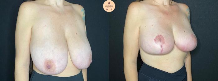 Before & After Breast Reduction Case 90 Right Oblique View in San Antonio, Texas