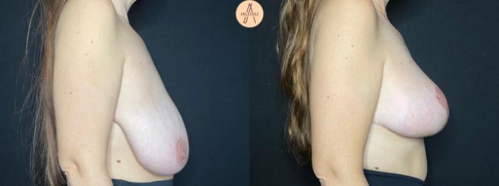 Before & After Breast Reduction Case 90 Right Side View in San Antonio, Texas