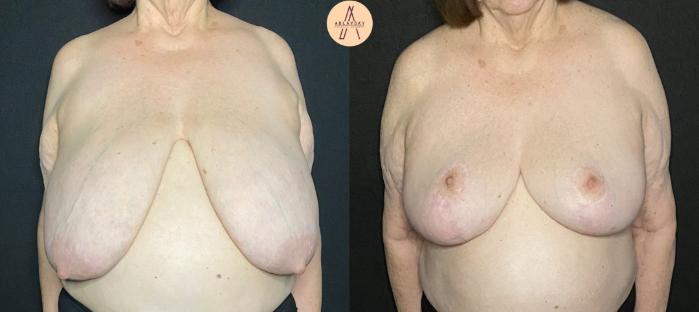 Before & After Breast Reduction Case 98 Front View in San Antonio, Texas